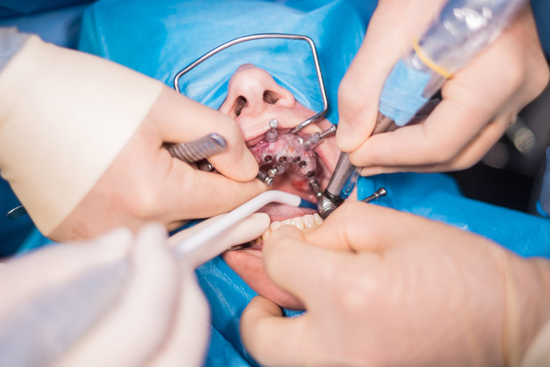 Which Type of Anesthesia Is Used for This Dental Surgery