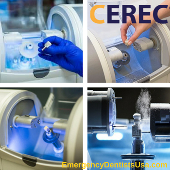 Why you should get a CEREC machine