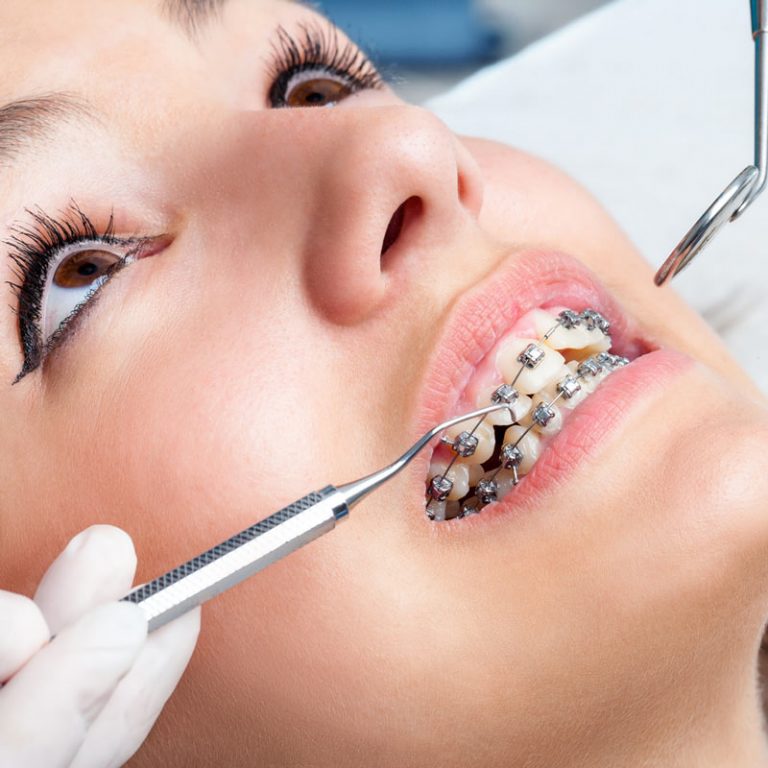Taking Care of Your Teeth After Braces 10 Things You Will Notice