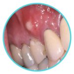 abscess tooth sign