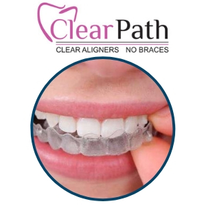 at home orthodontics clearpath