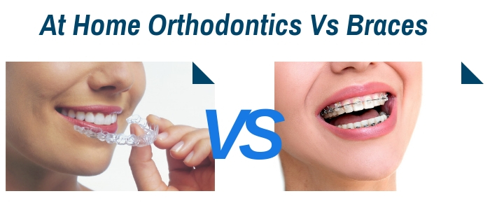at home orthodontics vs braces 1