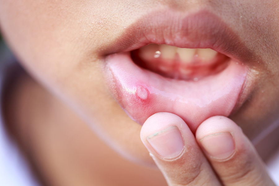 canker sores image