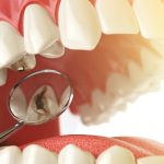 cavities between teeth featured image