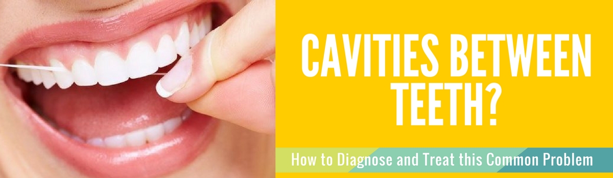 cavities between teeth