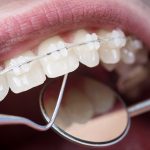 ceramic braces image