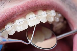 ceramic braces image