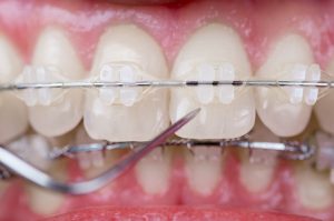 ceramic braces image