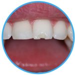 chipped or broken tooth el paso texas