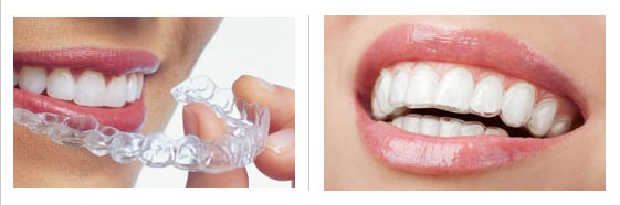 clear braces image