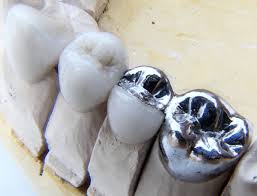 dental Bridge Fit