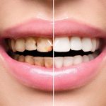 dental implants before and after featured image