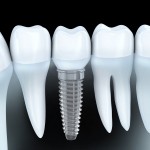 dental implants dallas tx