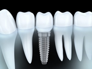 dental implants dallas tx