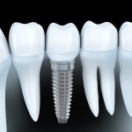 dental implants jacksonville fl