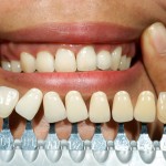 dental implants san francisco