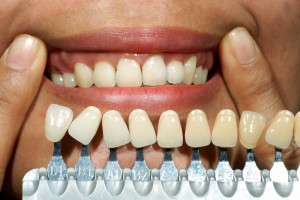 dental implants san francisco