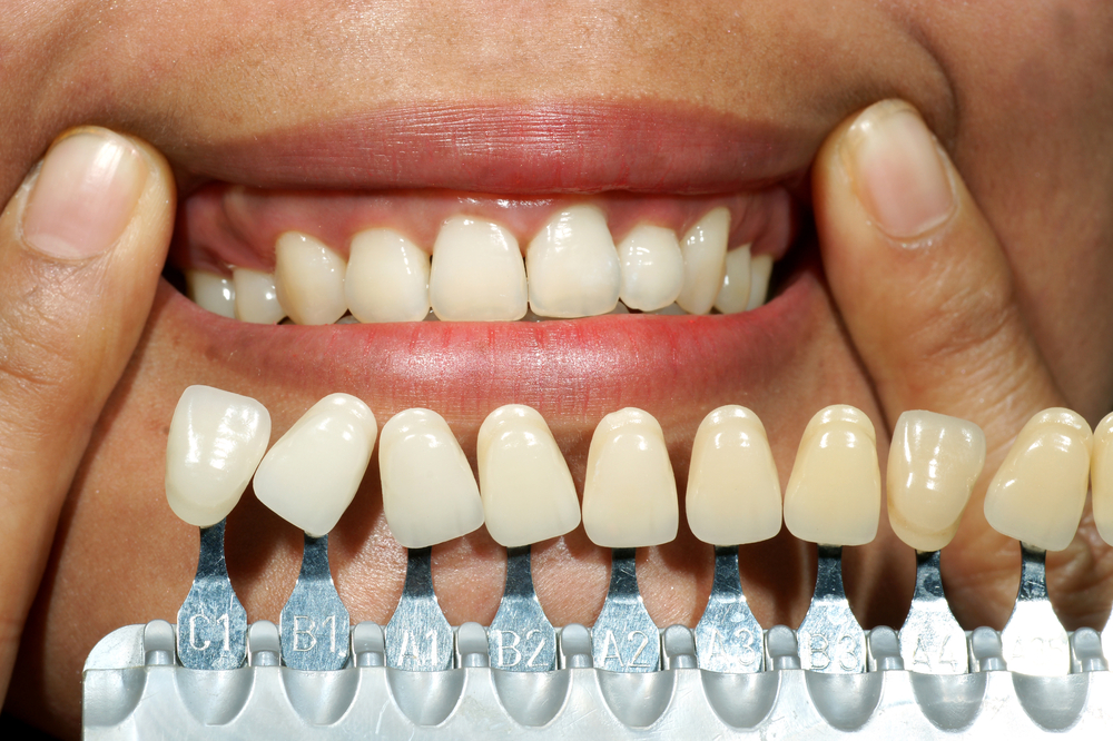 Dental Implants San Francisco Best S.F. Implant Dentists