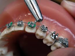 dental wire