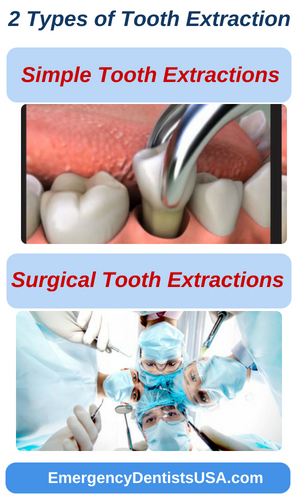 emergency tooth extractions types