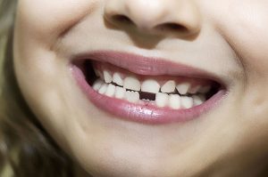 front teeth do not come into contact with their bottom teeth