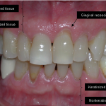 gingival abscess featured image
