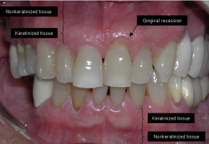gingival