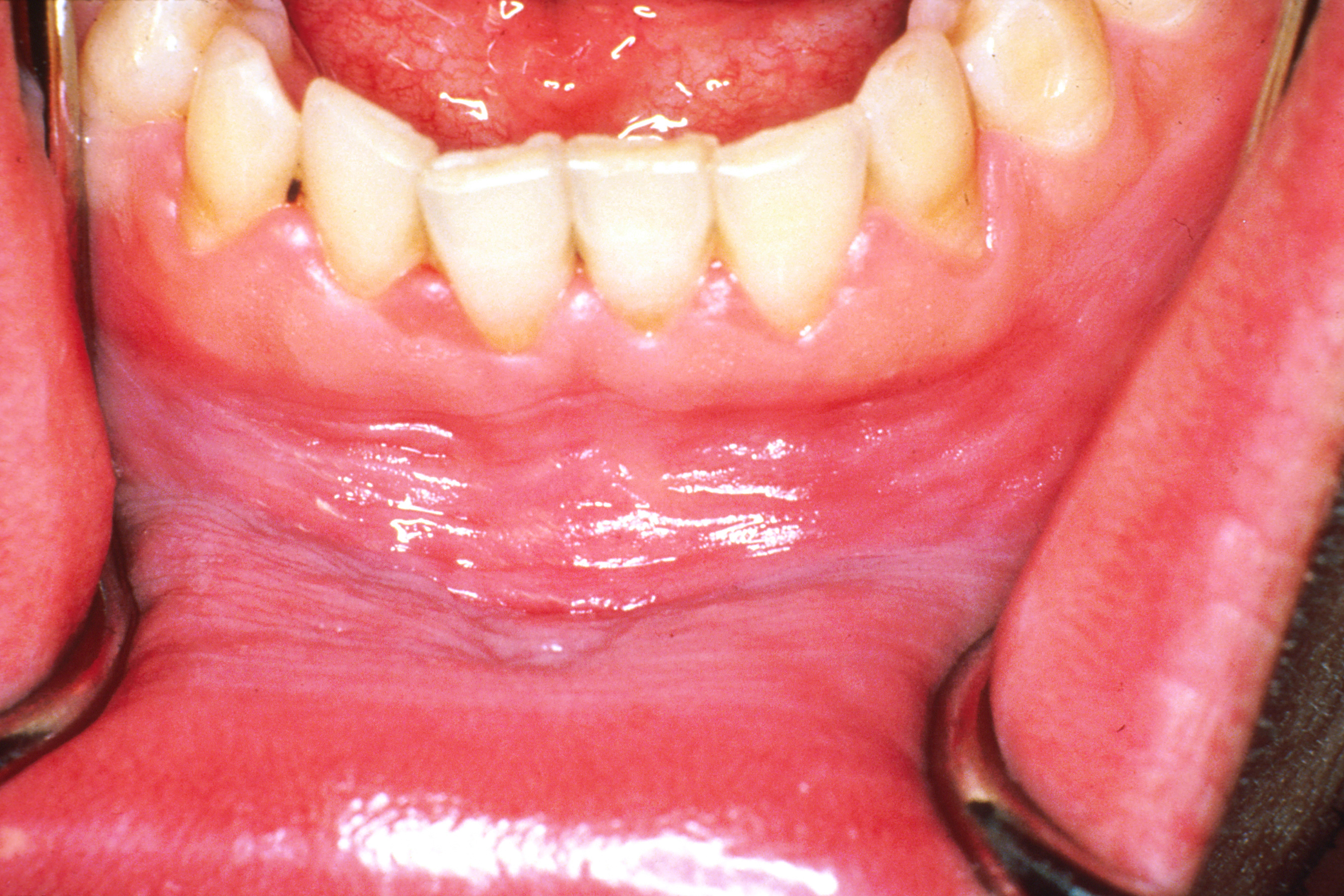 gum disease image