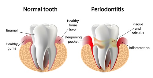 gum disease image