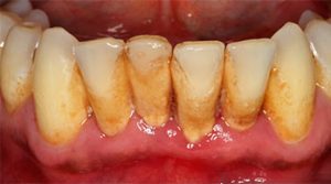 gum tissues problem