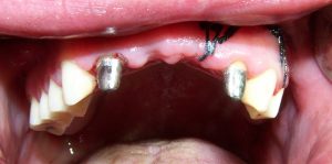 instructions for dental bridges