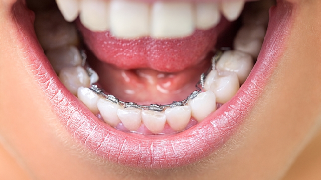 lingual braces image