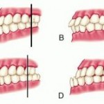 malocclusion of teeth 1