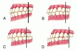 malocclusion of teeth 1