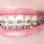 orthodontist indianapolis in