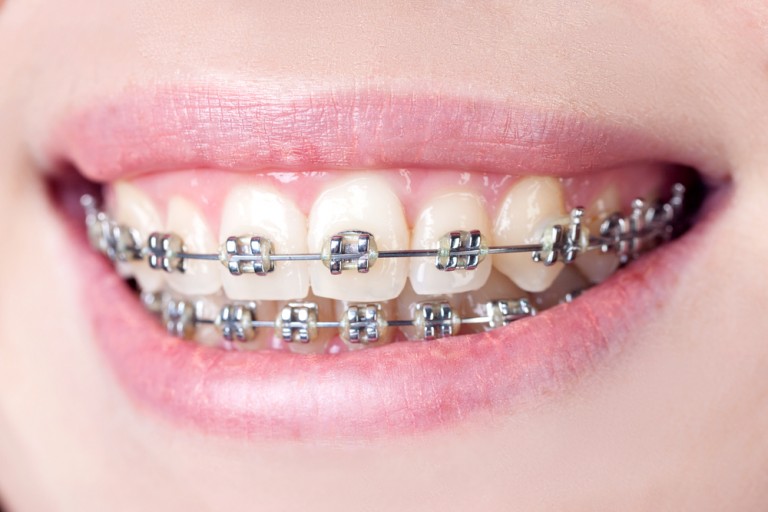 Orthodontists San Antonio Find The Best Orthodontists