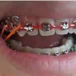 overbite braces featured image