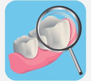 periodontal abscess image