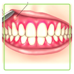 periodontal abscess teeth image