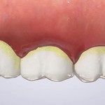 periodontal disease feature