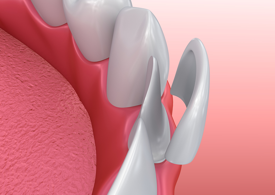 porcelain veneers image
