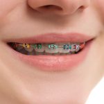 self ligating braces featured image