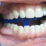 white bump on gums featured image