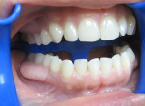 white bump on gums featured image