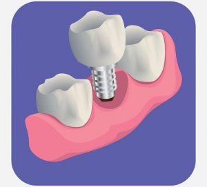 teeth implant image