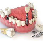 all on 4 dental implants featured image