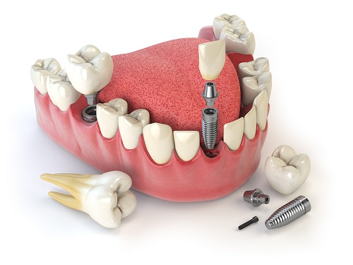 teeth implant image