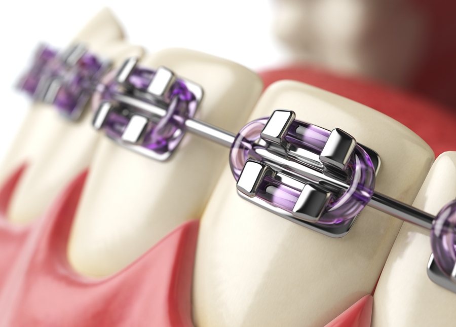 teeth with braces image