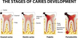 the Periodontal Disease Stages