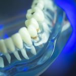 tooth decay stages featured image